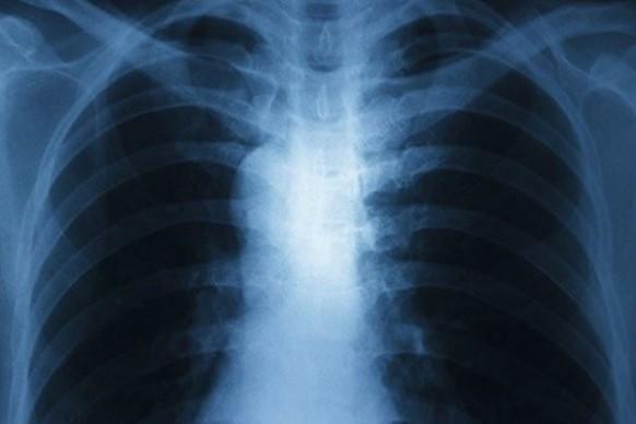 Professors at UM and Harvard collaborate in research on lung diseases